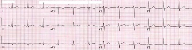 EKG of 46-year-old female suffering panic attacks