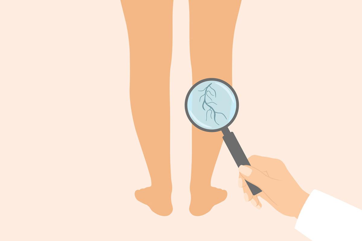 Magnifying glass over veins in a leg