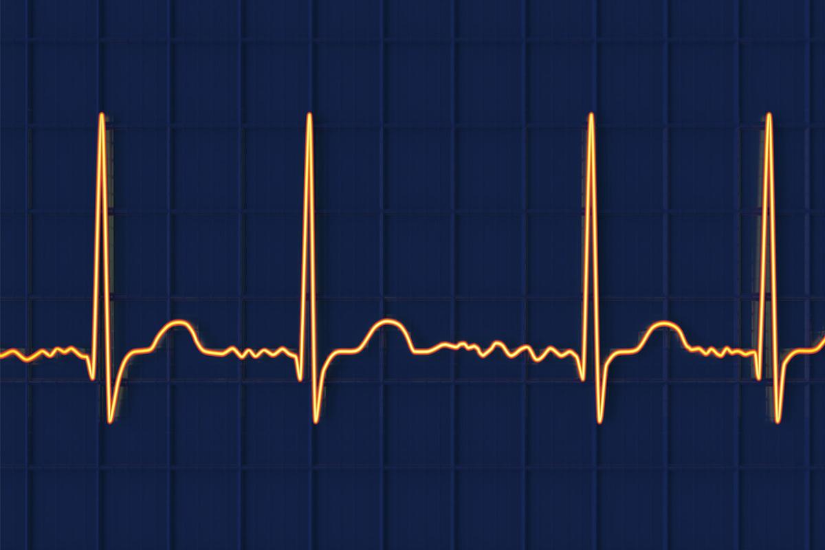 Atrial fibrillation irregular heartbeat rhythm